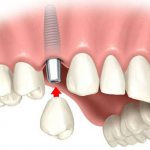 Implantation of teeth in the upper jaw