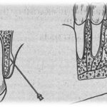 Infiltration anesthesia