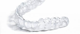 Overbite correction with Invisalign aligners