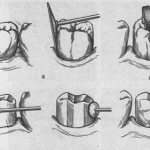 production of stamped crowns