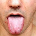 How to determine the causes of teeth marks on the sides of the tongue, and whether you should worry about it