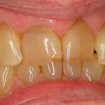 how to remove yellow plaque from cigarettes on teeth