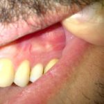 What does a dental cyst look like?