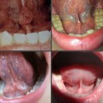 What does papilloma look like on the frenulum of the tongue?