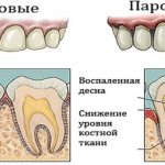 What does periodontal disease look like?