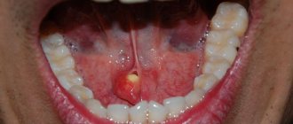 Stones in the salivary gland ducts