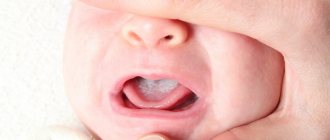 кандидоз полости рта у ребенка