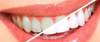 Teeth whitening pencil reviews bliq