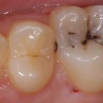 Кариес на жевательной поверхности зуба