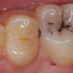 Caries on the chewing surface of the tooth