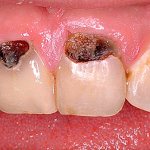 Caries on the side of the tooth