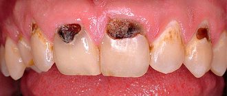 Caries on the side of the tooth