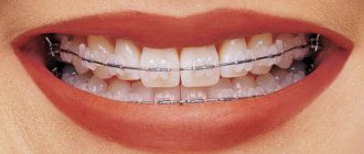 ceramic braces or veneers