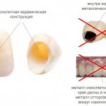 Керамическое протезирование