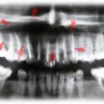 Cysts of the dentofacial area. Extensive bone defects. 