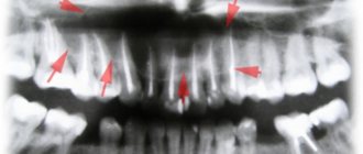 Cysts of the dentofacial area. Extensive bone defects. 