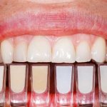 composite veneers