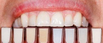 composite veneers