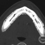 Computed tomography of a jaw affected by phosphorus necrosis