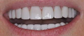 Crowns on front teeth