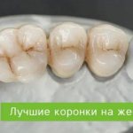 коронки на жевательные зубы