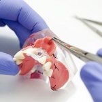 Bone grafting