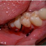 Bone grafting after treatment of a dental cyst