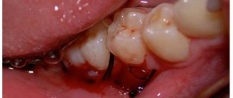 Bone grafting after treatment of a dental cyst