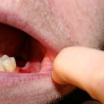 Кровотечение после удаления зуба - норма, однако если оно долго не прекращается, стоит обратиться к врачу