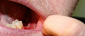 Bleeding after tooth extraction is normal, but if it does not stop for a long time, you should consult a doctor.