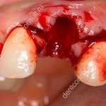 bleeding after tooth extraction