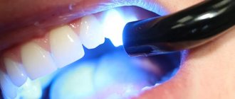 laser whitening