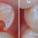 Treatment and tooth filling