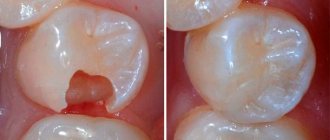 Лечение и пломбирование зуба