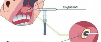 Treatment of maxillary sinus cyst