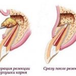 &#39;treatment of dental cysts dentistry &quot;Ritsa&quot;&#39;