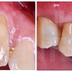 treatment of wedge-shaped defect