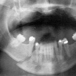 Treatment of a displaced fracture