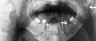 Treatment of a displaced fracture