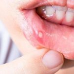 Treatment of stomatitis in children