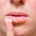 ointment on the lip