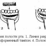 Small vestibule of the oral cavity in children