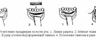 Мелкое преддверие полости рта у детей