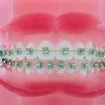 Metal braces