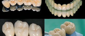 Metal-ceramic crowns