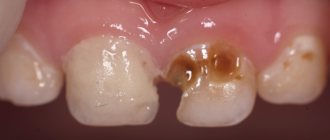 Baby teeth are more susceptible to caries than permanent teeth