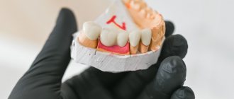 Мост на жевательные зубы выполненный из металлокерамики для пациента