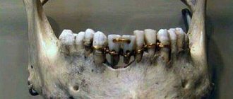 bridge with donor teeth