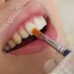 Is it possible to whiten ceramic teeth?