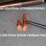 The photograph clearly shows that both incisors have damage: the root part of the teeth was destroyed, eaten away, and these teeth could not be saved. Surgeon Magomed Dakhkilgov 